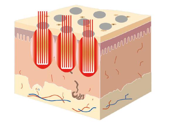 痘坑毛孔粗永久解决,毛孔大痘坑大粉底液遮不住怎么办