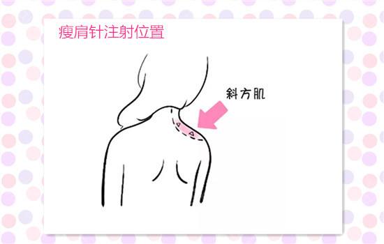 瘦肩针有用吗真实测评,中医认为瘦肩针有副作用吗