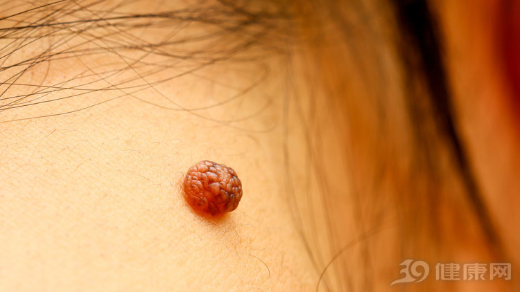 身上有红痣是肝病的前兆吗,皮肤上长红痣要当心是肝病的征兆