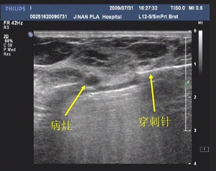 乳腺纤维腺瘤怎么回事,乳腺纤维腺瘤怎么治最好