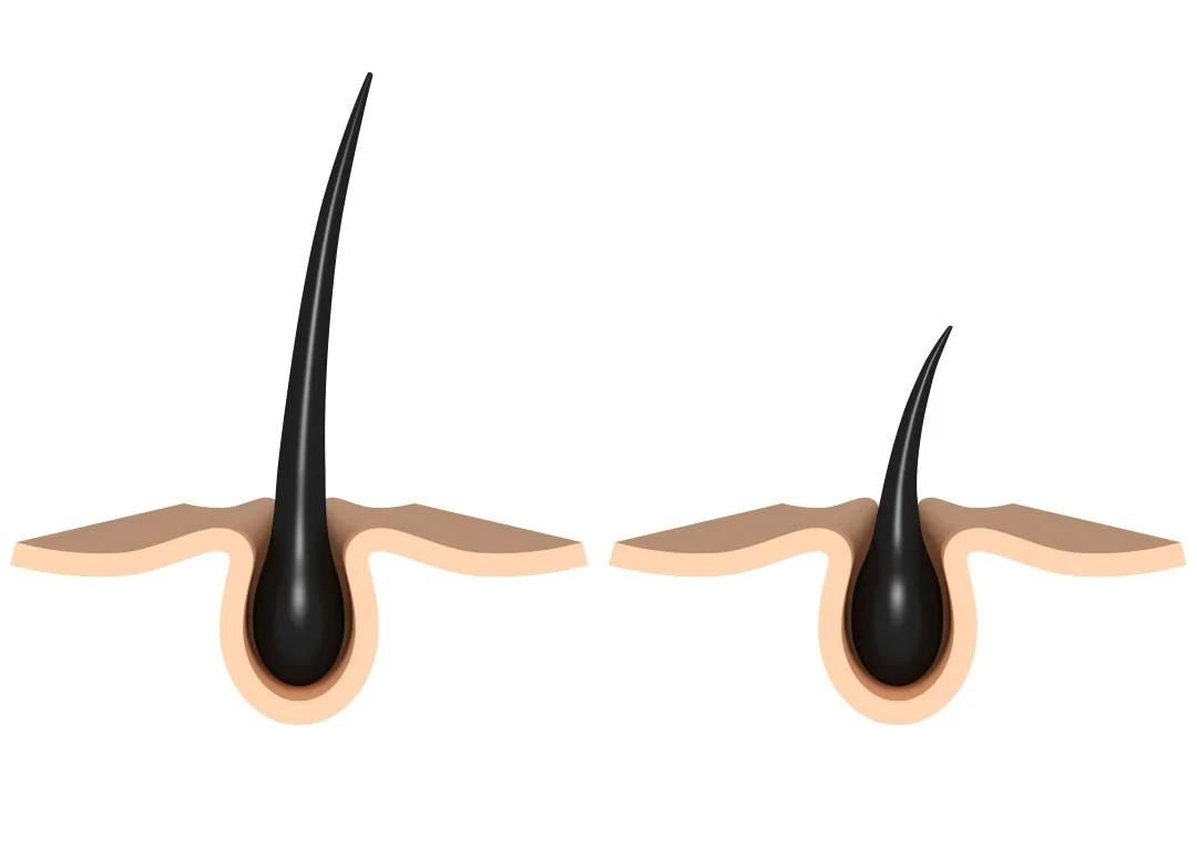 头发变细油腻脱发怎么回事,咨询一下有没有秃头的前兆