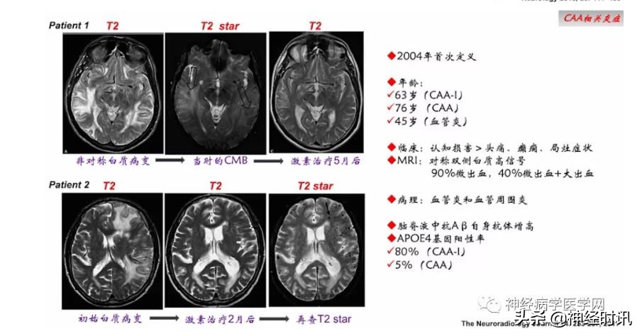 缺血性脑血管病出血评估,脑血管微出血怎么治疗