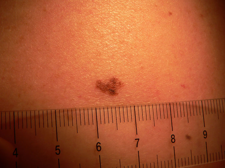 身上出现小红点一定要注意,身上的小红点是什么原因怎么治疗