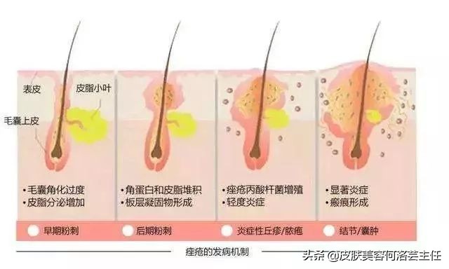 治疗痤疮用的避孕药有哪些,为什么治疗痘痘需要避孕药