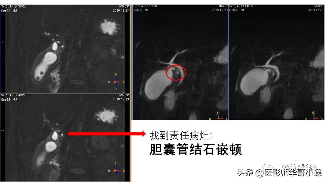 「飞利浦磁共振技术」胆道系统胆胰管水成像之3D_MRCP_BH