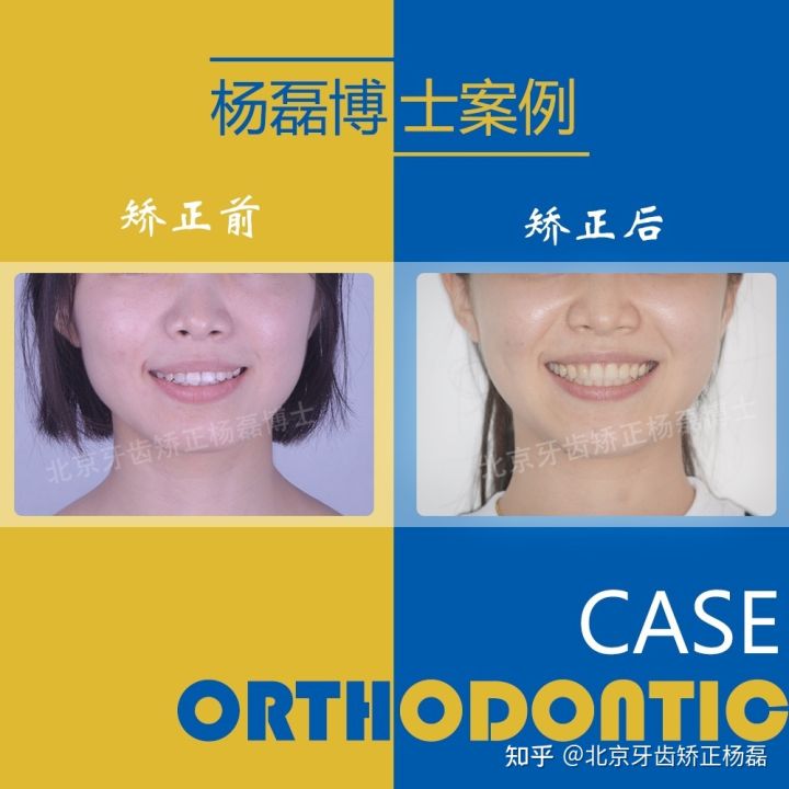 北京牙齿矫正大约要多少钱,北京哪个医院看牙齿矫正比较好