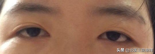 做完双眼皮还是肿着怎么办,全切双眼皮松解后能变回单眼皮吗