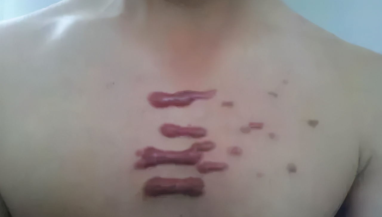 胸前疤痕疙瘩祛疤手术一般多少钱,胸前有一个蝴蝶状疤痕疙瘩怎么治