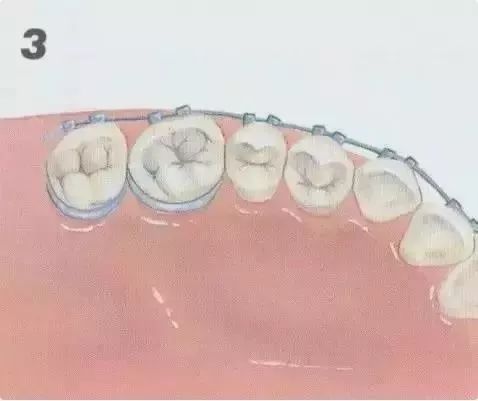 钢丝矫正效果好吗,钢丝矫正一般要用多少钱