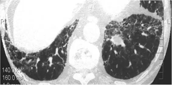 间质性肺疾病看病经验分享,分享肺腺癌临床实验的例子