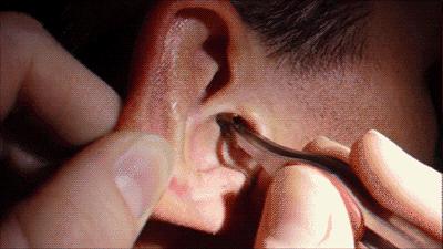 耳屎一定要全部清除吗,耳屎到底要不要挖终于知道答案了