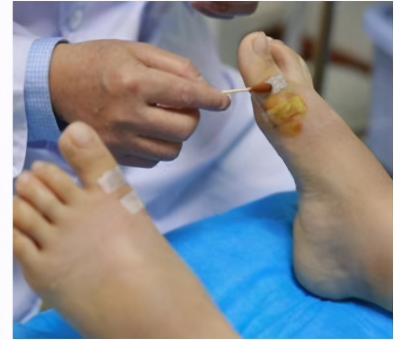 皮肤擦伤有渗出液,皮肤擦伤涂什么药