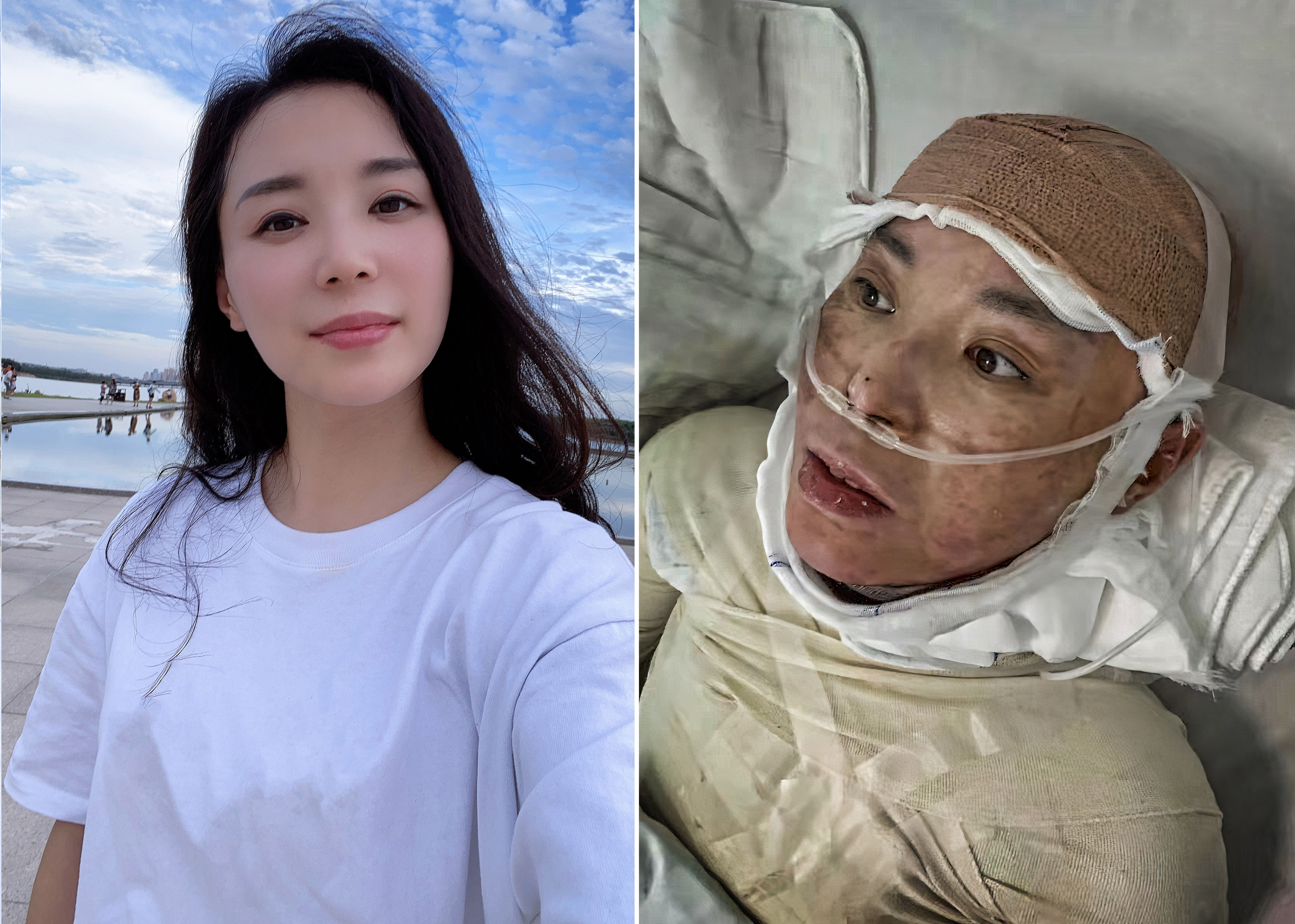 美女辣妈拔火罐烧伤如戴紧箍咒,美妈凌晨拔火罐烧伤