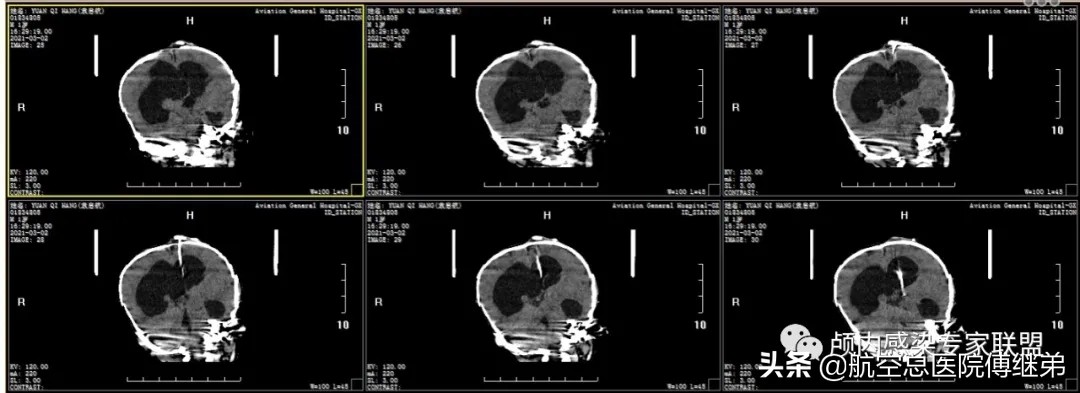婴儿脑积水治疗方法动画演示,ommaya囊植入术是大手术吗