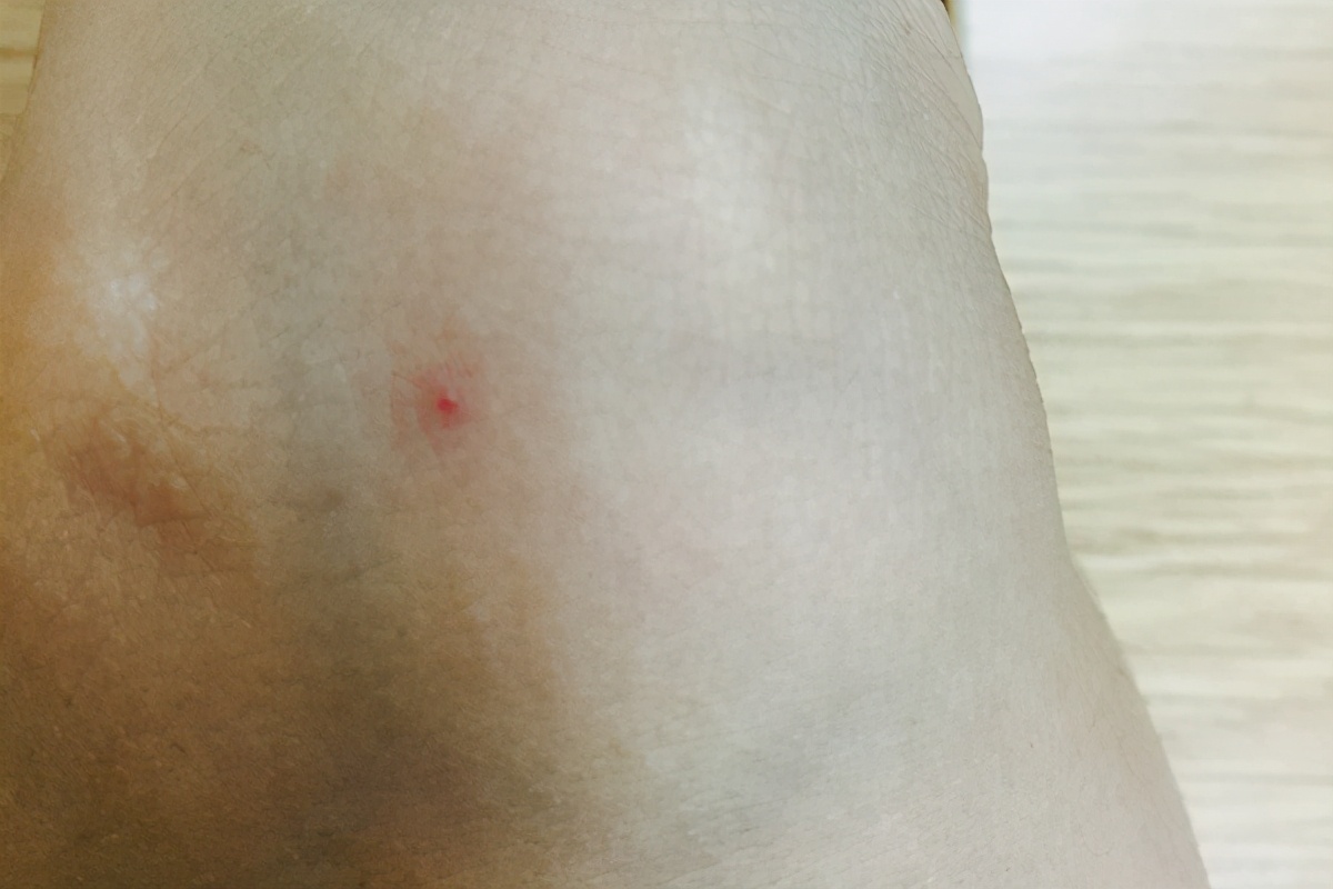 每年体检肝都没问题面部长蜘蛛痣,脸上出现蜘蛛痣就代表肝有毛病吗