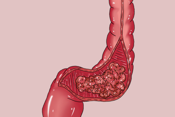 肠息肉是怎么形成的要注意什么,肠息肉是怎样形成的怎么治疗