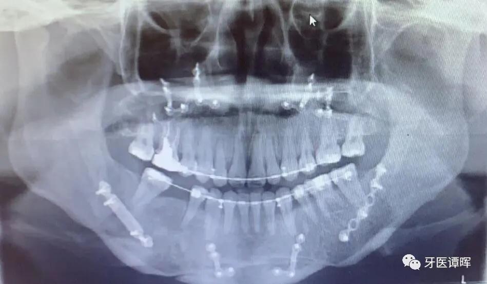 超详细的牙齿矫正过程,重叠牙齿矫正变化过程
