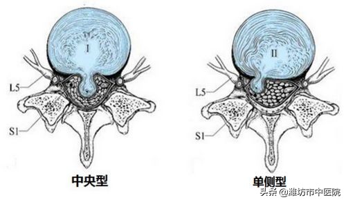 针灸治疗腰椎间盘突出几次有效果,针灸女性腰椎间盘突出视频观看