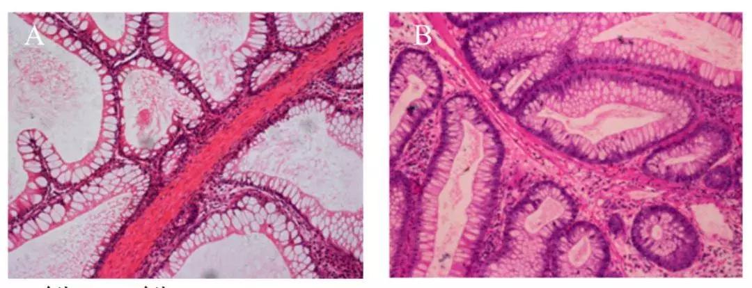 肠内有息肉脸上会长斑吗,有唇斑是肠道息肉吗