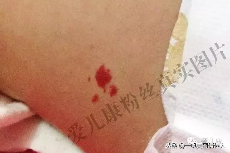 宝宝身上有点小红点,宝宝身上红色胎记但是不凸起