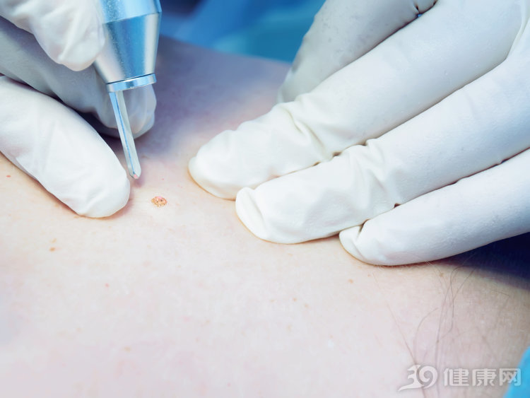 祛痣不想祛了,祛痣后色素沉着怎么去除