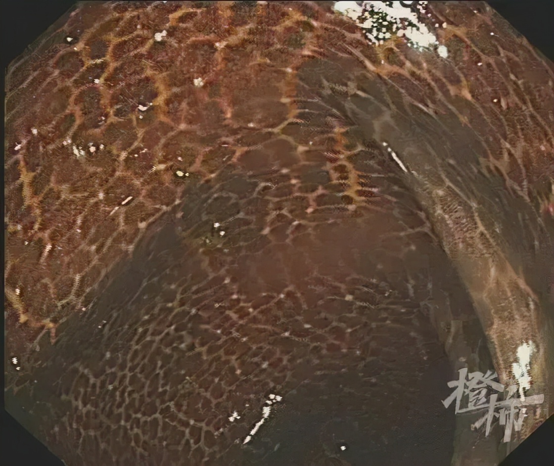 吃了5年的酵素,阿姨吃酵素三年肠子表面变蛇皮