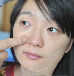 鼻炎小窍门教你如何保护自己鼻子,鼻炎鼻子如何护理