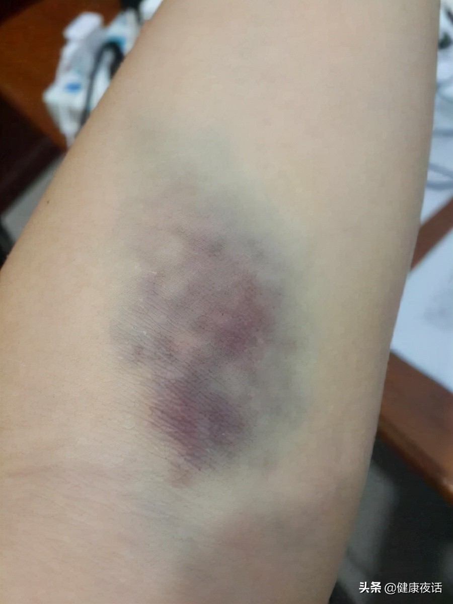 手臂抽血后鼓包肿了青紫疼痛,抽血后鼓包了要怎么处理