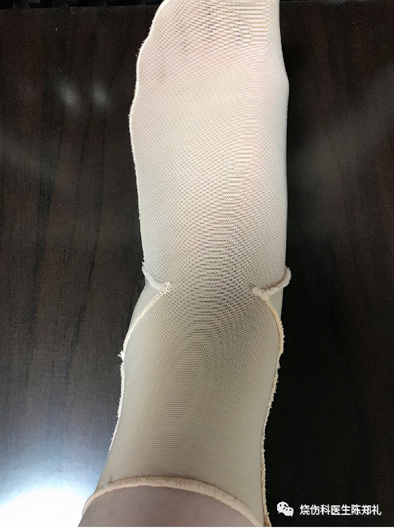 疤痕疙瘩怎么治疗最好最快,疤痕疙瘩中药治疗成功案例