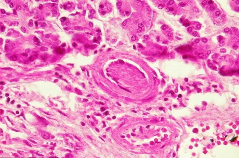 儿童常见特发性血小板减少性紫癜（ITP）的发病原因