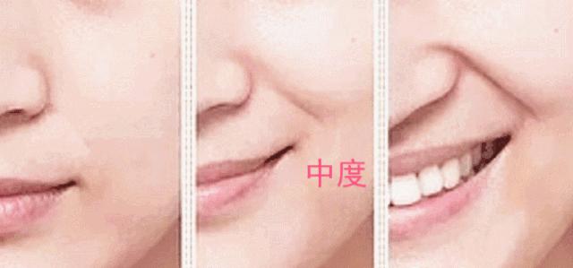 漱口的动作可以淡化法令纹吗,有法令纹做什么项目好