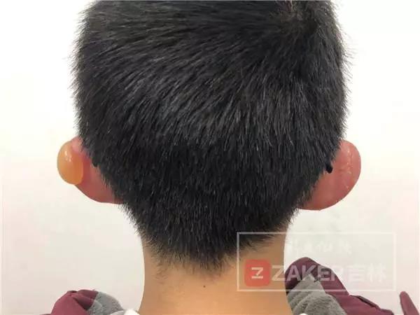 疼！看着就心疼！东北男孩大冷天踢足球冻伤！这些细节值得家长注意