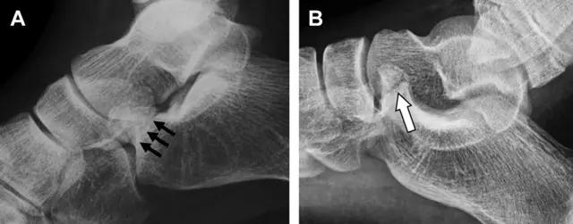 放射科夜班病例大全,放射科容易漏诊的骨折