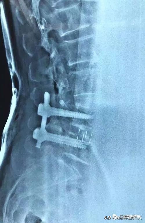 内镜下腰椎融合术步骤,腰椎融合内固定术后注意事项