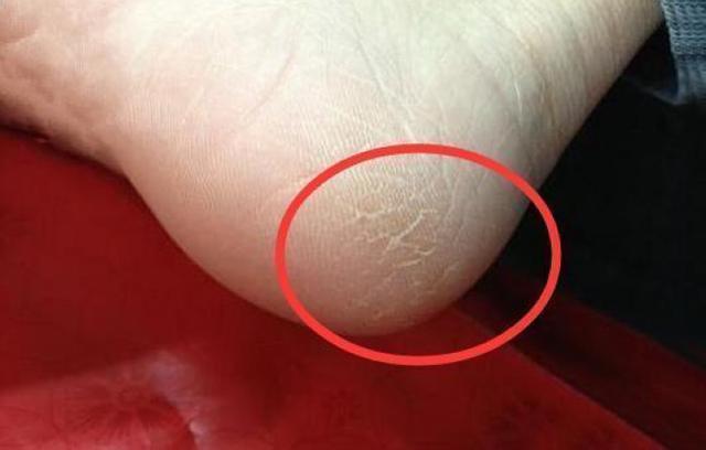 手脚皮肤干裂怎样快速保湿,缓解手脚干裂的小妙招