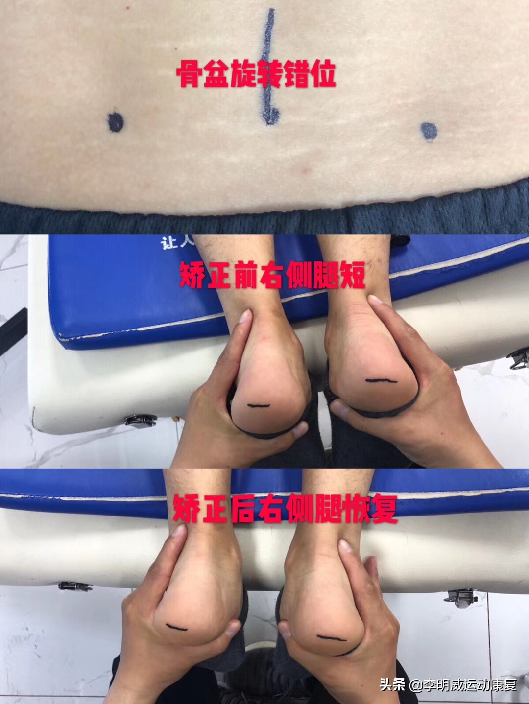 骨盆不正导致腿不直,骨盆不正导致的长短腿症状