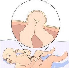 宝宝脐疝怎么办？儿科医生说，宝宝出现这些情况，要立刻送医