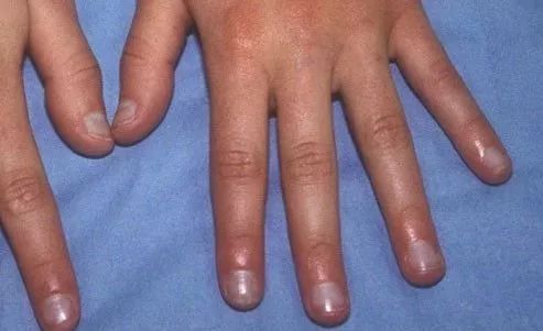 娃指甲上有白点是怎么回事,孩子指甲横纹有白点