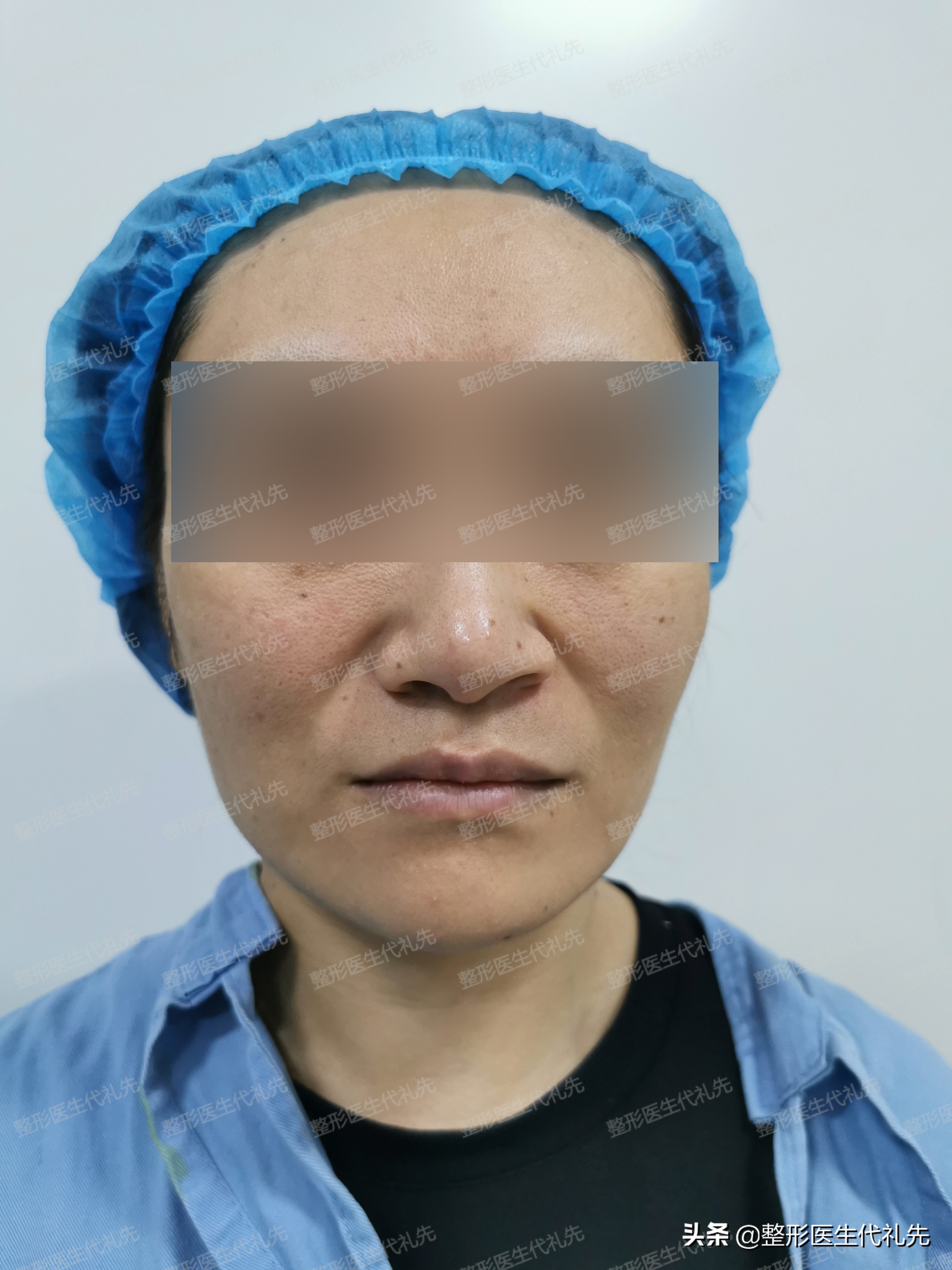 49岁女人做小拉皮术后恢复,50岁女人拉皮手术后脸变化