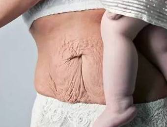 产后妊娠纹怎么去除,产后祛除妊娠纹最有效的方法