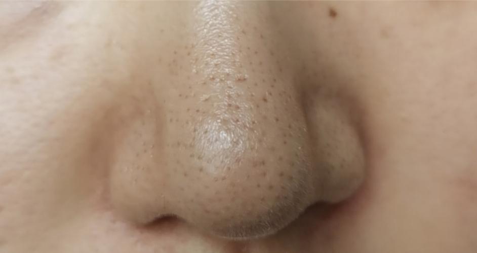 皮肤科医生怎么处理黑头,皮肤科医生怎样去黑头粉刺最简单