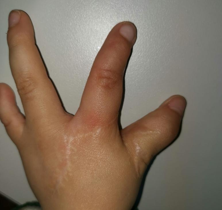 并指畸形免植皮案例,并指畸形