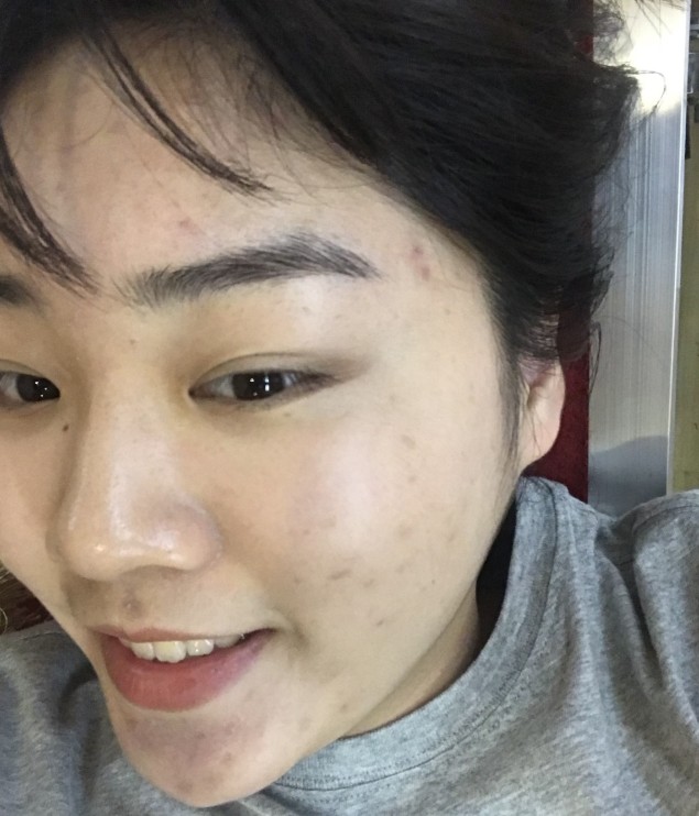 男生会喜欢脸上有痘的吗,男生会喜欢脸上有斑的女生吗