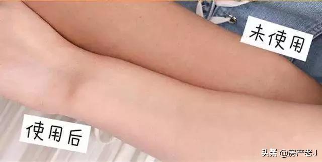 腿上有鱼鳞皮屑怎么办,腿上起皮屑就是鱼鳞病