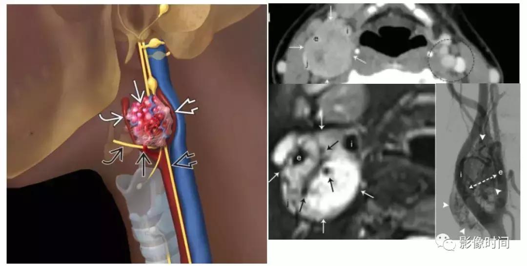 双侧颈动脉鞘间隙多发小淋巴结影,双侧颈动脉间隙多软组织密度结节