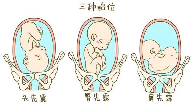 头先露可以顺产吗,头先露和枕先露各有几种胎位