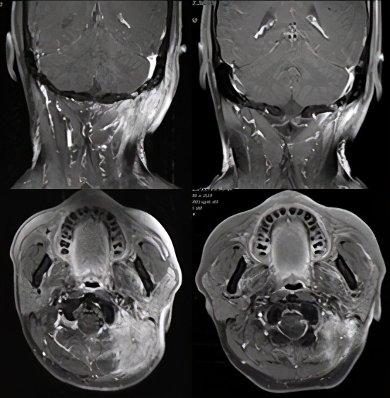 pd-1抑制剂适用的肿瘤类型,pd-1抑制剂能用于癌症晚期么