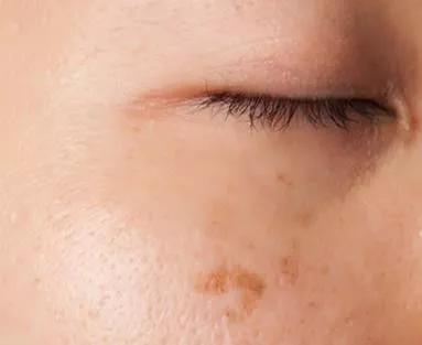 片仔癀护肤品去斑有效吗,片仔癀的护肤品祛斑吗