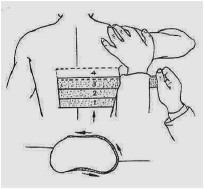 中医诊疗方案肋骨骨折,肋骨骨折的中医治疗方法