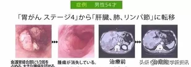 癌症患者的生存几率多大,国内癌症医疗和国外癌症医疗现状